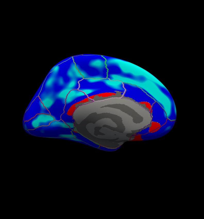 lh-Avg_thickness-age-Cor-sig.mgh-0.01thresh.jpg