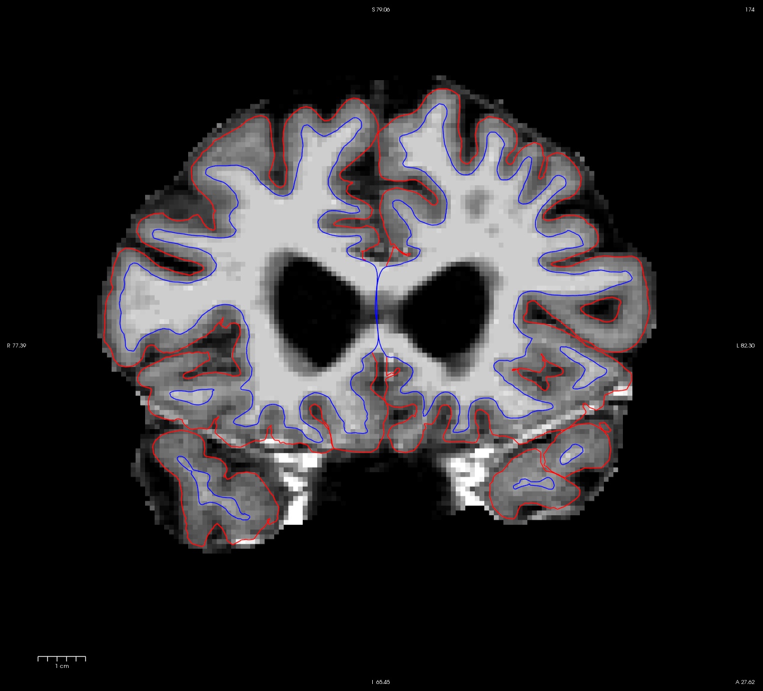 ps_slice_174_base_before.jpg